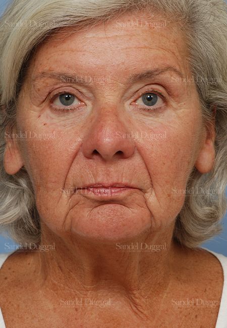 Laser Skin Resurfacing before, case 2950