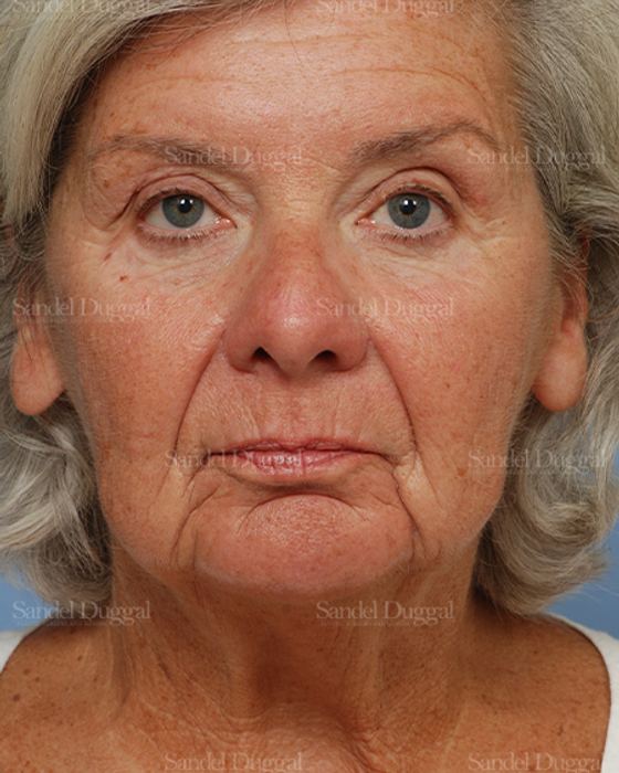Laser Skin Resurfacing before, case 2950