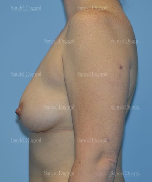 Breast Augmentation before, case 3066