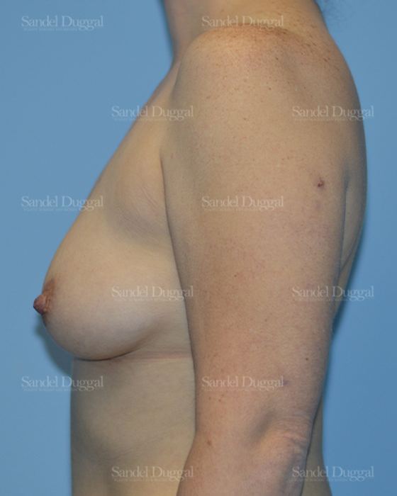 Breast Augmentation before, case 3066