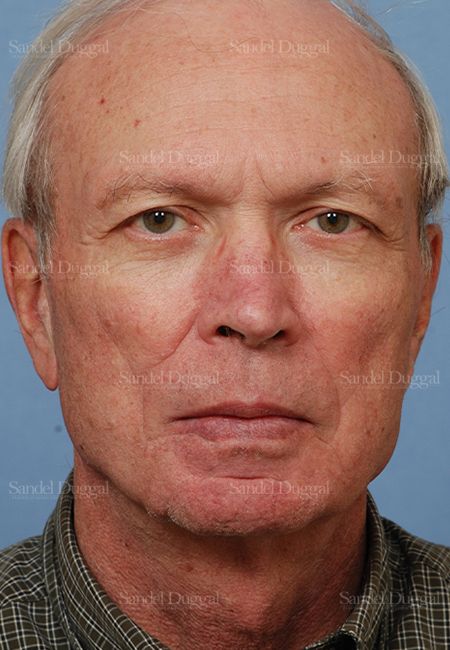 Reconstruction after Mohs after, case 2775