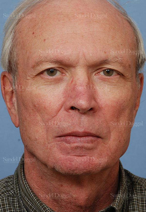 Reconstruction after Mohs after, case 2775