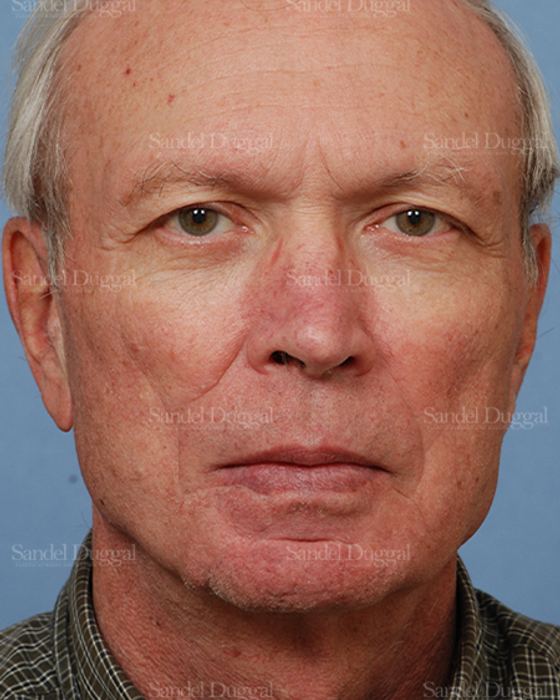 Reconstruction after Mohs after, case 2775