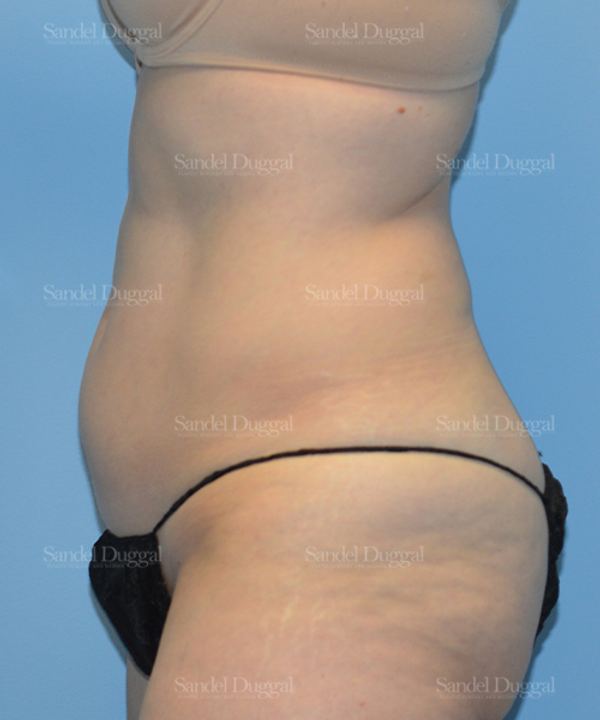 Liposuction — Abdomen before, case 2469