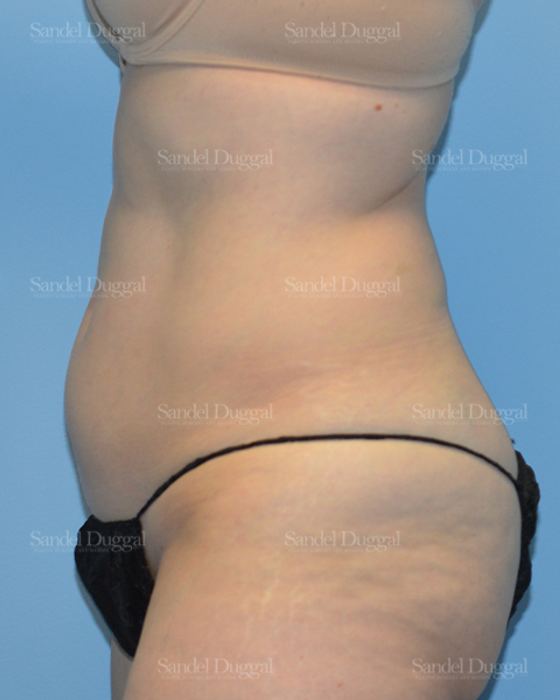 Liposuction — Abdomen before, case 2469