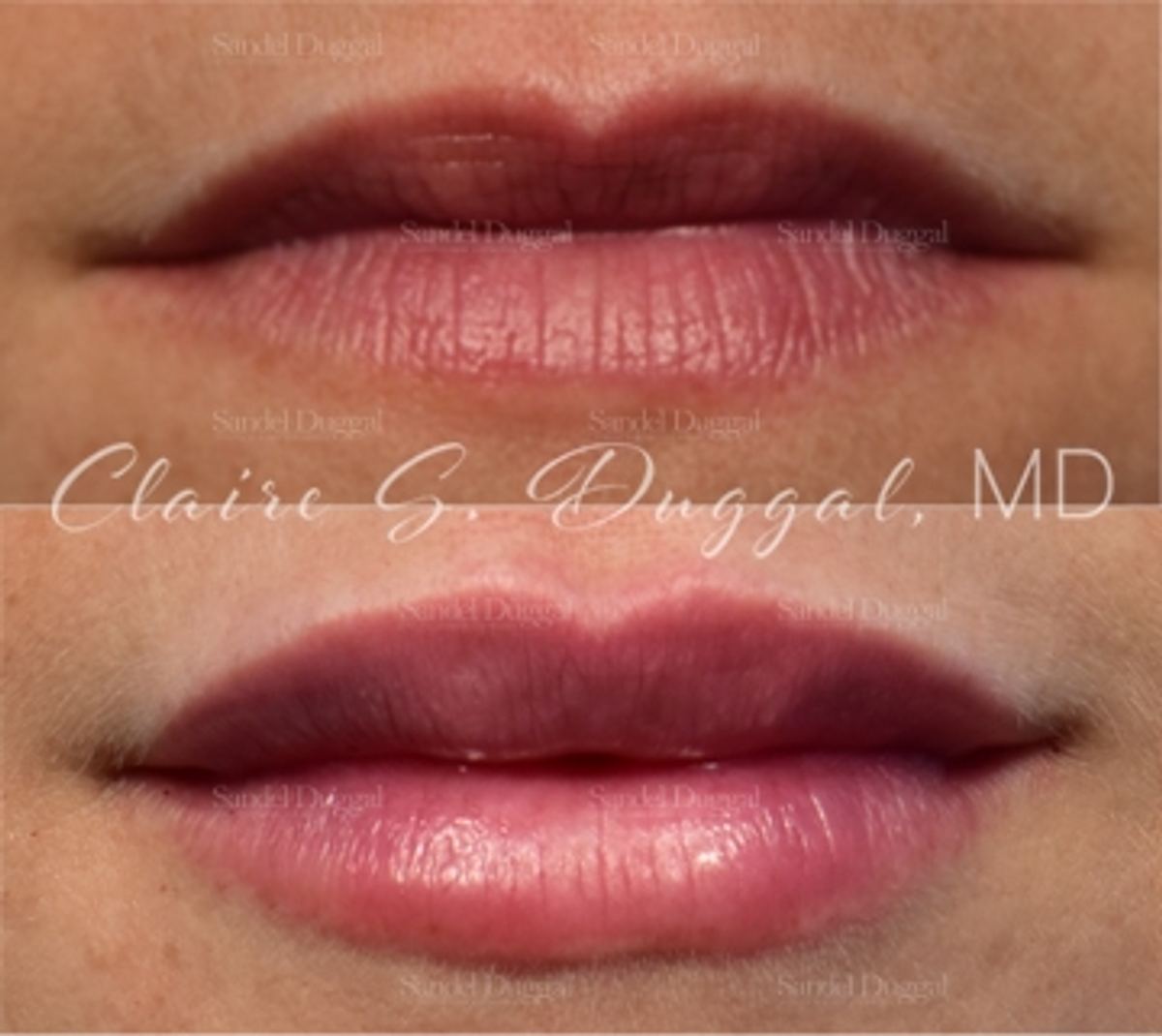 Lip Augmentation / Lip Lift before and after, case 4366