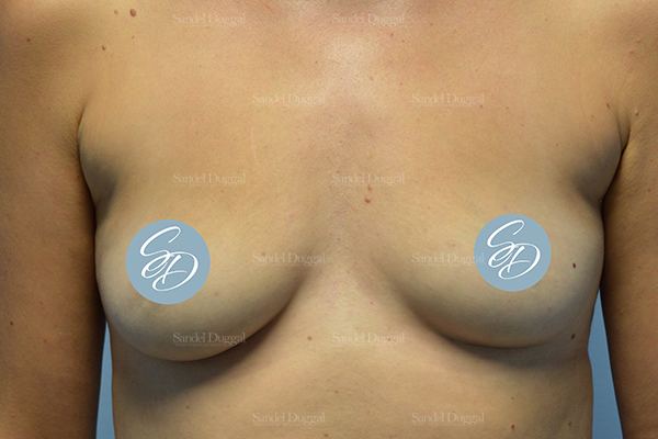 Liposuction — Bra Roll before, case 2489
