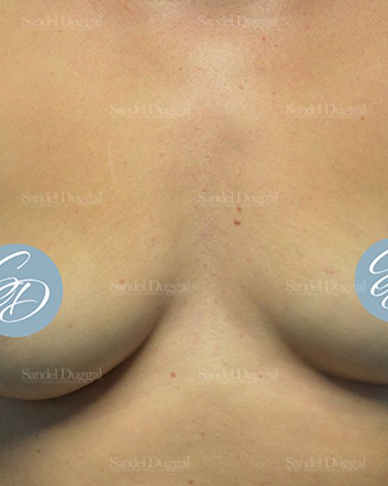 Liposuction — Bra Roll before, case 2489