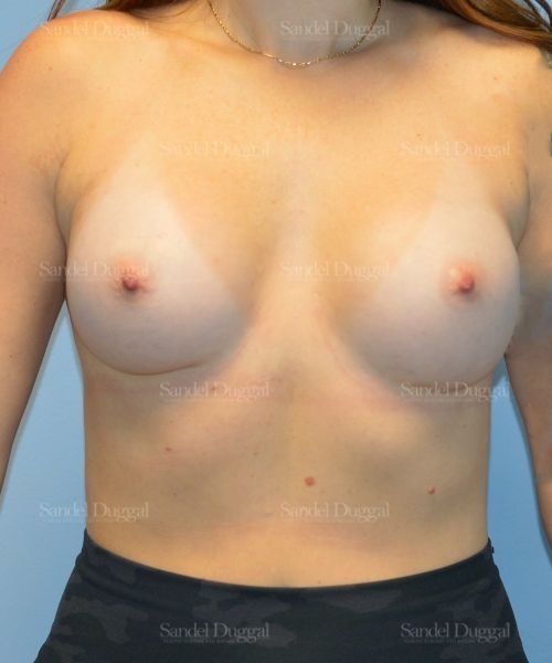 Breast Augmentation after, case 4764