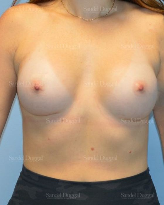 Breast Augmentation after, case 4764