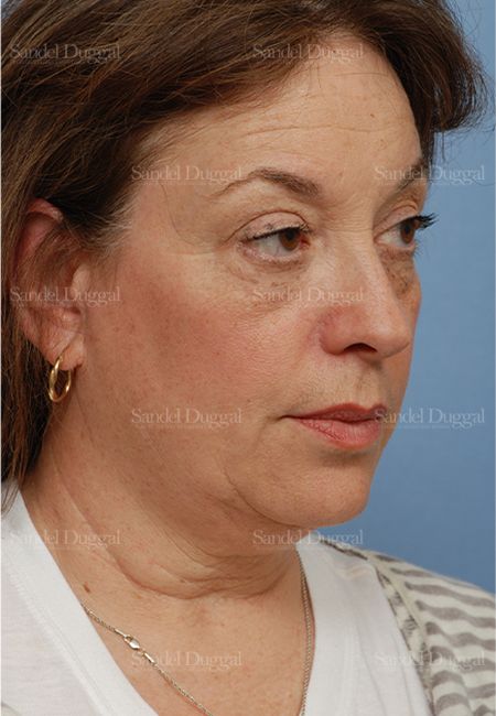 Facelift before, case 813