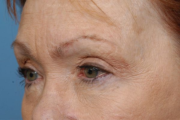 Eyelid Rejuvenation before, case 1930