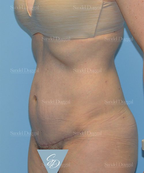 Tummy Tuck after, case 1652