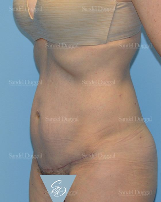 Tummy Tuck after, case 1652