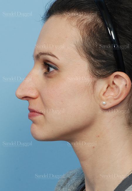 Rhinoplasty before, case 2831