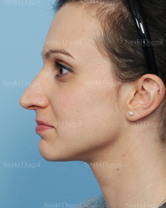 Rhinoplasty before, case 2831
