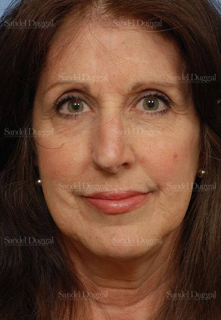 Reconstruction after Mohs after, case 2793