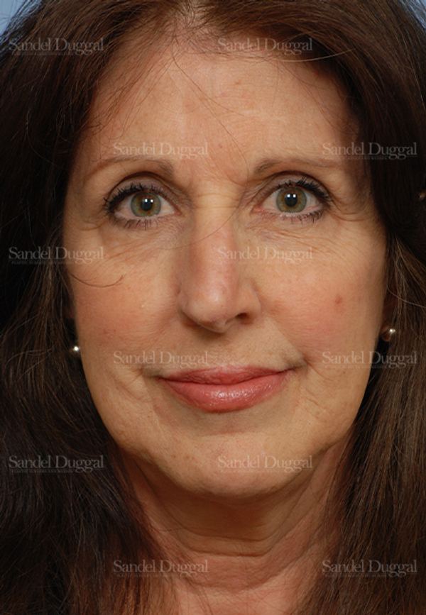 Reconstruction after Mohs after, case 2793