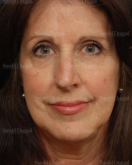 Reconstruction after Mohs after, case 2793