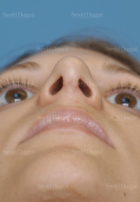 Rhinoplasty after, case 2885
