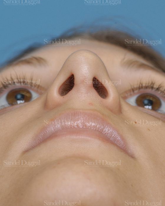 Rhinoplasty after, case 2885