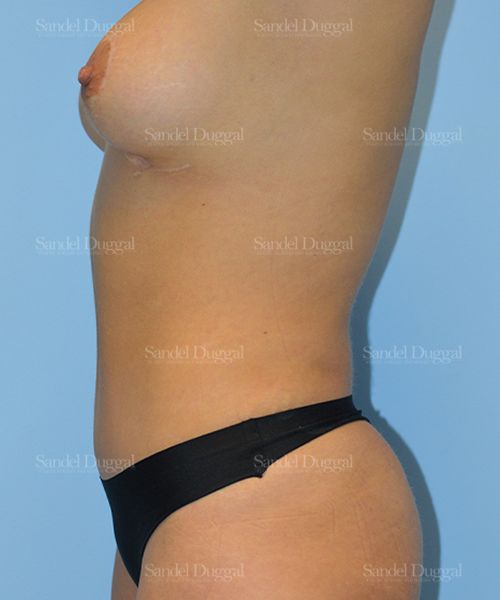 Tummy Tuck after, case 1680