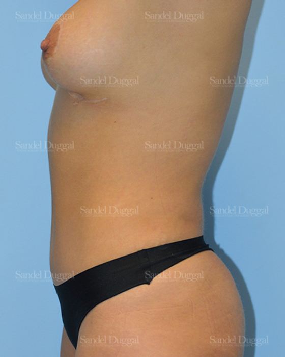 Tummy Tuck after, case 1680