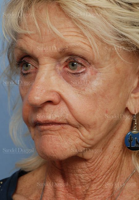 Cheek Augmentation before, case 1446