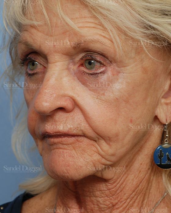 Cheek Augmentation before, case 1446
