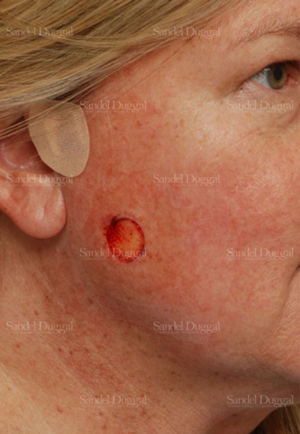 Reconstruction after Mohs before, case 2724