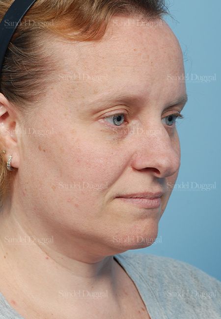 Rhinoplasty before, case 2862