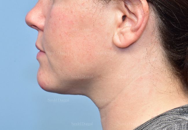 Neck & Chin Liposuction after, case 5359