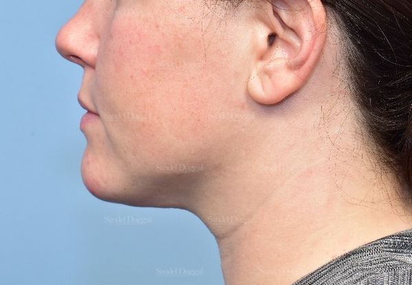 Neck & Chin Liposuction after, case 5359