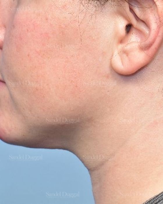 Neck & Chin Liposuction after, case 5359