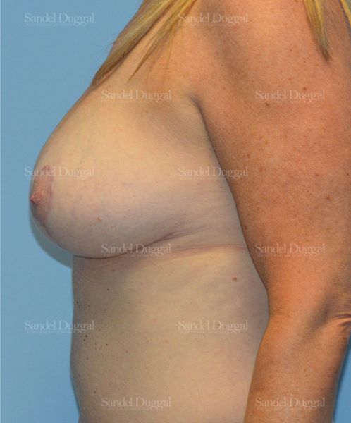 Breast Augmentation with Lift after, case 3442
