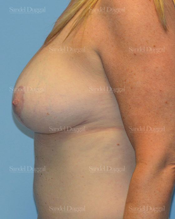 Breast Augmentation with Lift after, case 3442