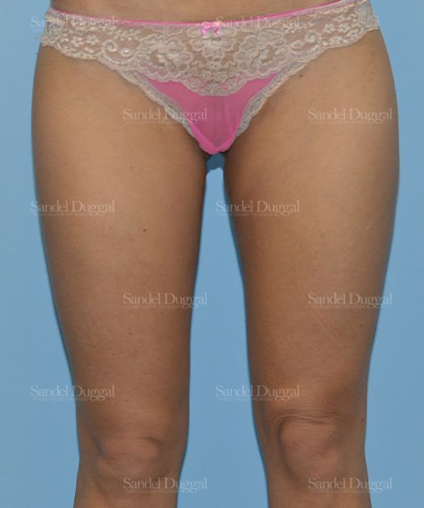 Liposuction — Legs & Flanks after, case 2540