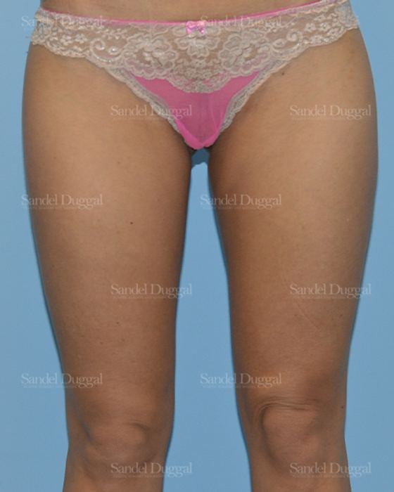 Liposuction — Legs & Flanks after, case 2540