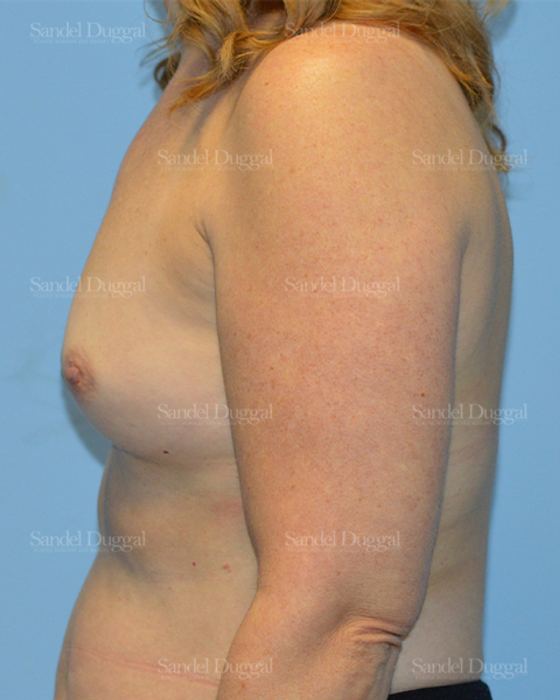 Breast Augmentation before, case 3094