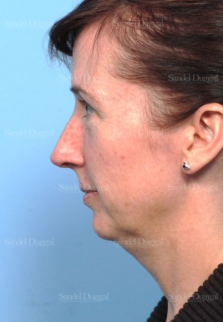 Facelift before, case 2647
