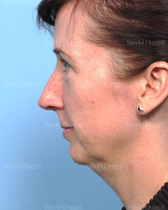 Facelift before, case 2647