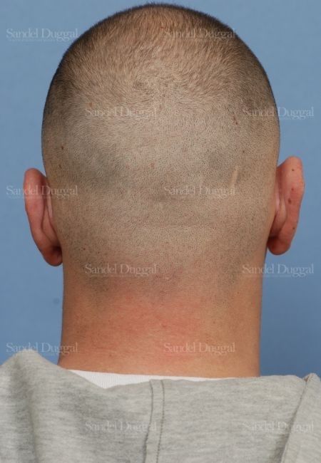Otoplasty after, case 4068