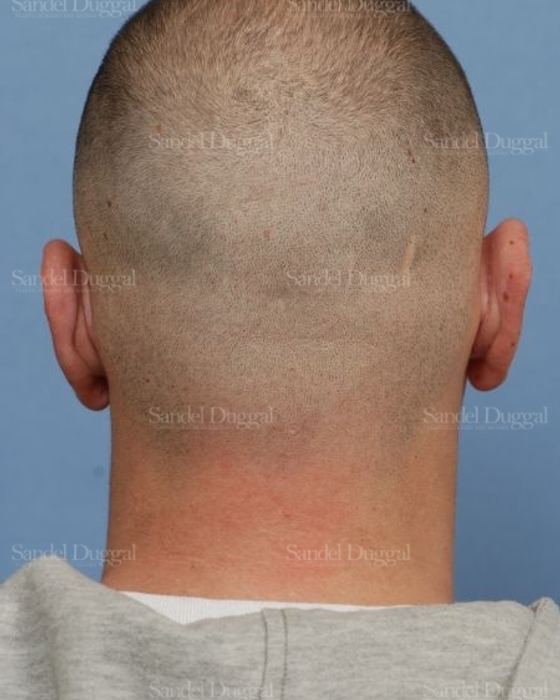 Otoplasty after, case 4068