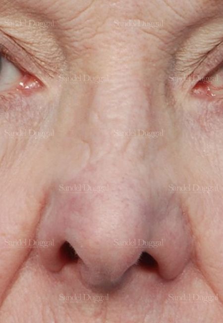 Revision Rhinoplasty before, case 2614