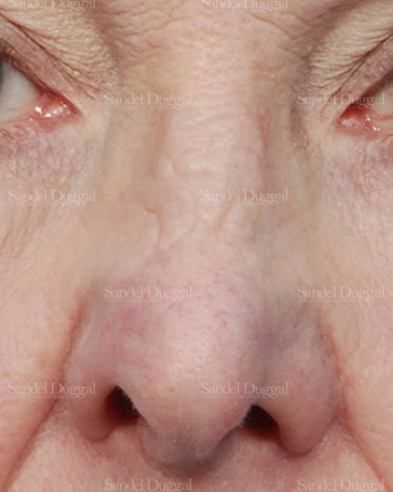 Revision Rhinoplasty before, case 2614