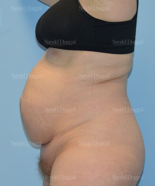 Tummy Tuck before, case 1666
