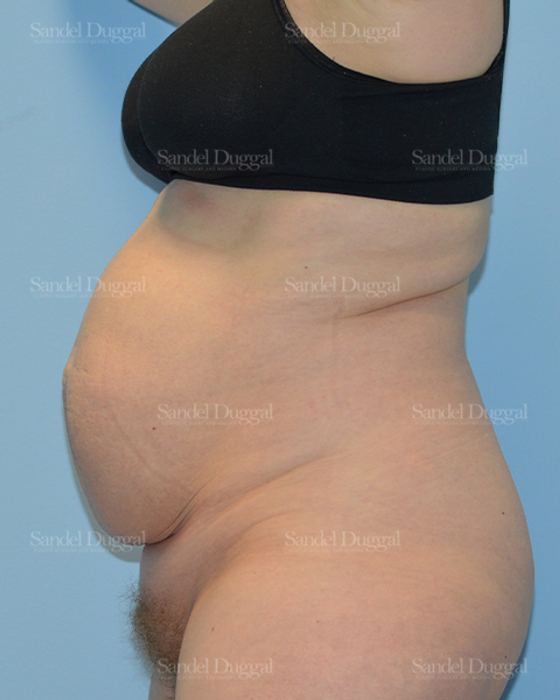 Tummy Tuck before, case 1666