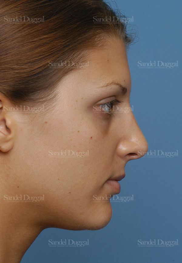 Rhinoplasty after, case 2885
