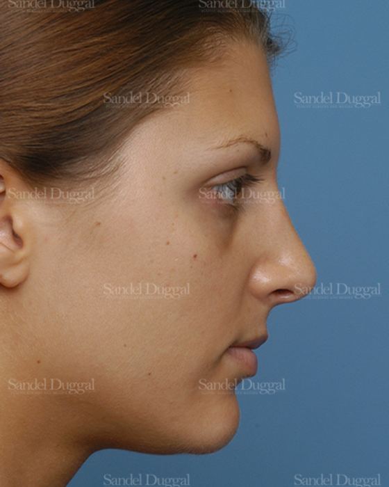 Rhinoplasty after, case 2885