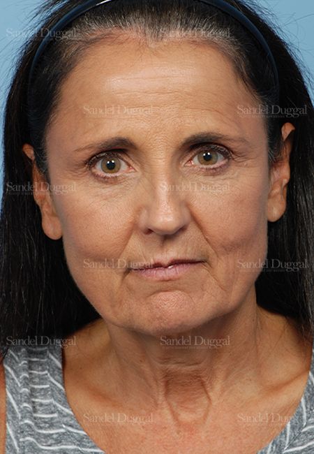 Facelift before, case 2661